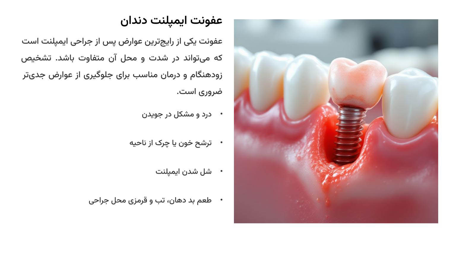 عفونت ایمپلنت دندان
