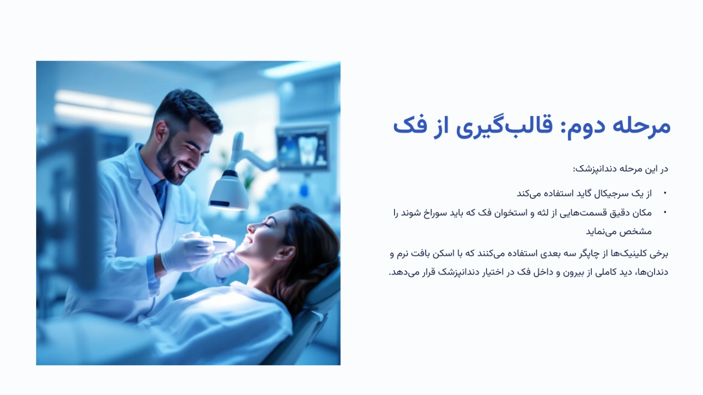 مرحله دوم ایمپلنت دیجیتال قالبگیری از فک