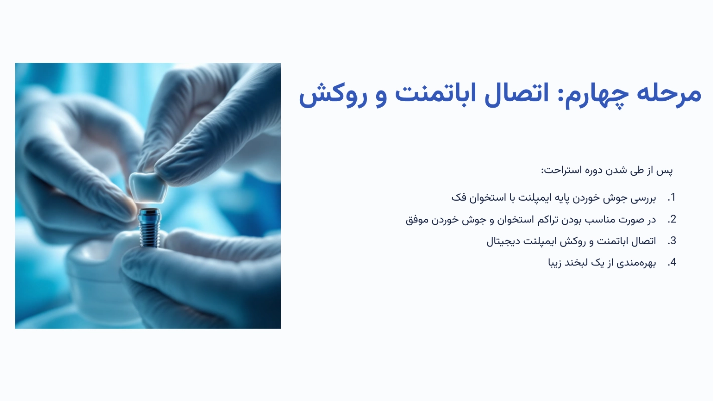 مرحله چهارم ایمپلنت دیجیتال؛ اتصال اباتمنت و روکش