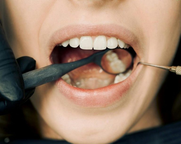 تفاوت کامپوزیت و لمینت چیست؟