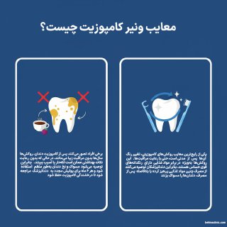 در این تصویر در رابطه با دو معایب کامپوزیت ونیر که شامل تغییر رنگ و نیاز به مراقبت مداوم است، صحبت شده است.