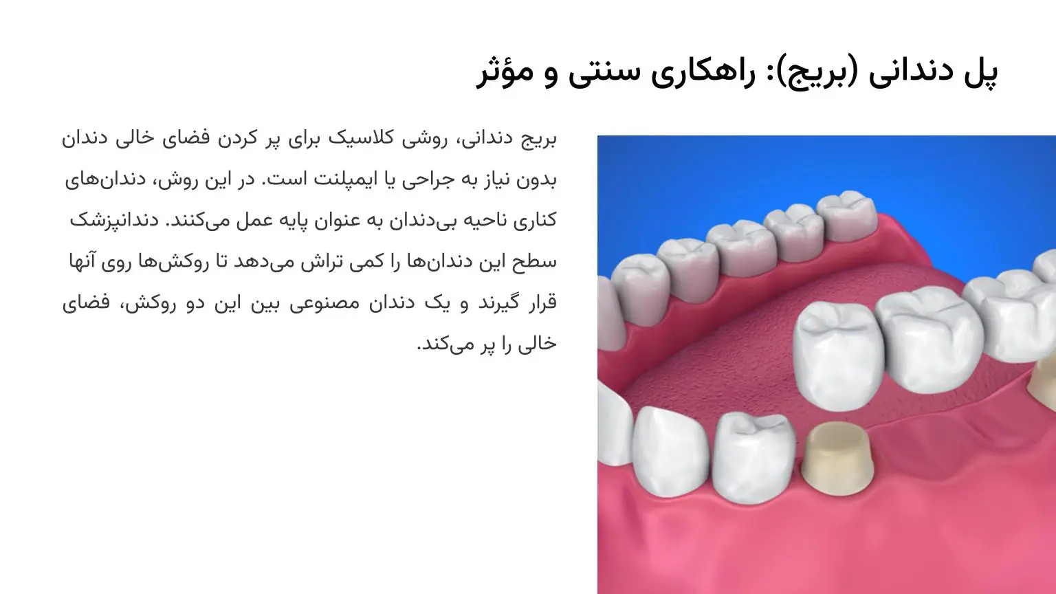 منظور از کاشت دندان با بریج (پل دندان) چیست؟