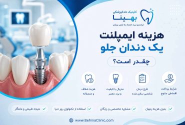هزینه ایمپلنت یک دندان جلو چقدر است؟